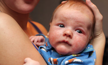 Biologická léčba pomáhá i pacientům s lupénkou